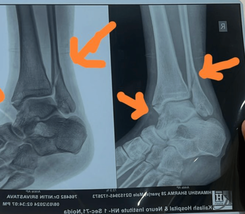 Broken-ankle-due-to-improper-running-posture